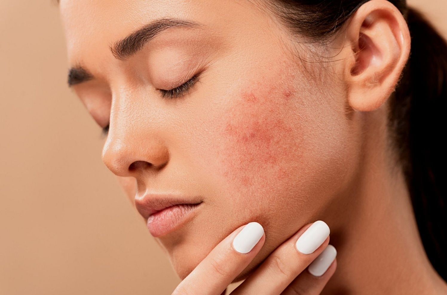 Should You Use a Humidifier for Acne?- You May Be Surprised