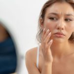 Managing Heat Rash
