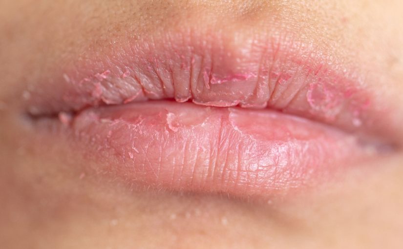 Can a Humidifier Help With Chapped Lips