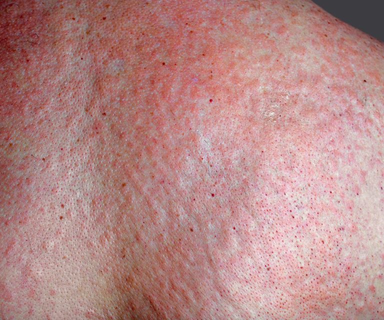 Heat Rash Management Managing Heat Rash: Relief & Prevention