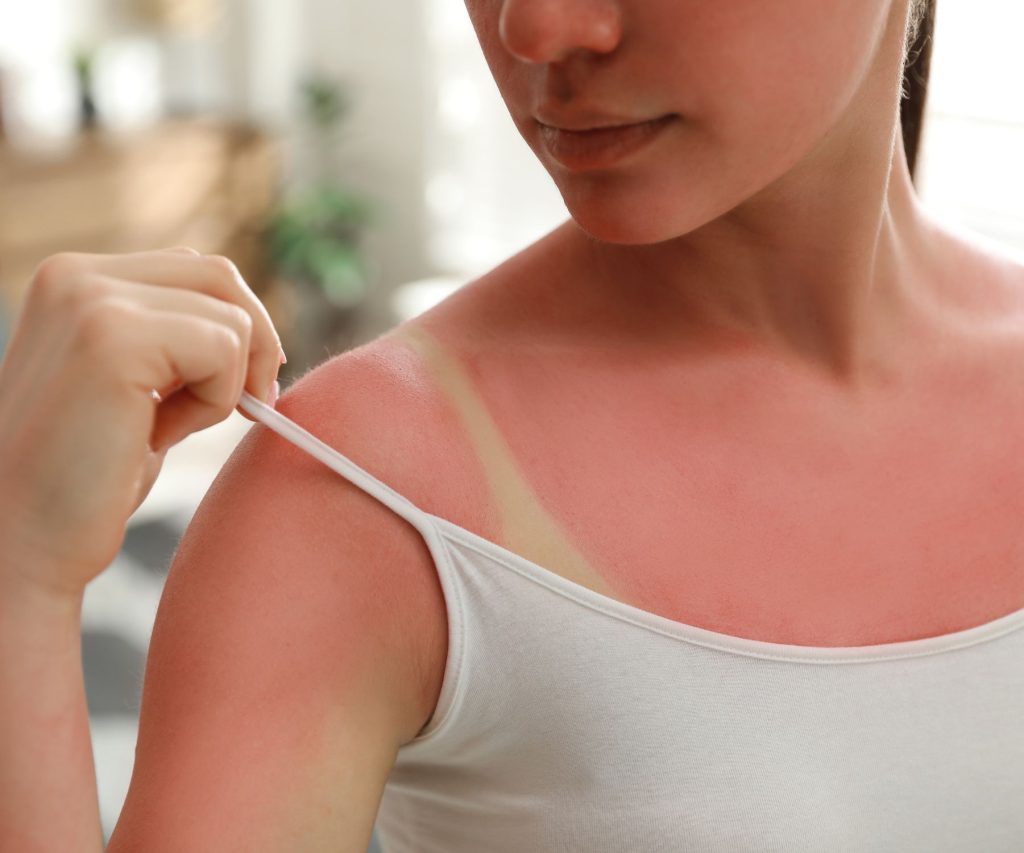 avoid sunburn by following the proper uv index 
